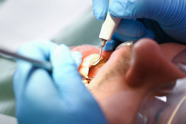 Best Emergency Wisdom Tooth Extraction in West Rson, CA